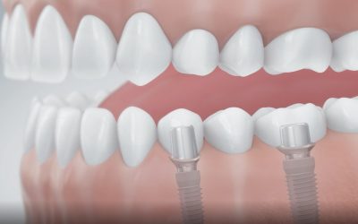 Zahnimplantate – eine besonders elegante Form der dritten Zähne